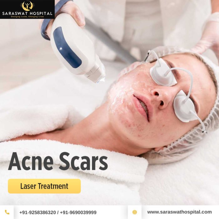 What to Know Before Going for an Acne Scar Treatment?