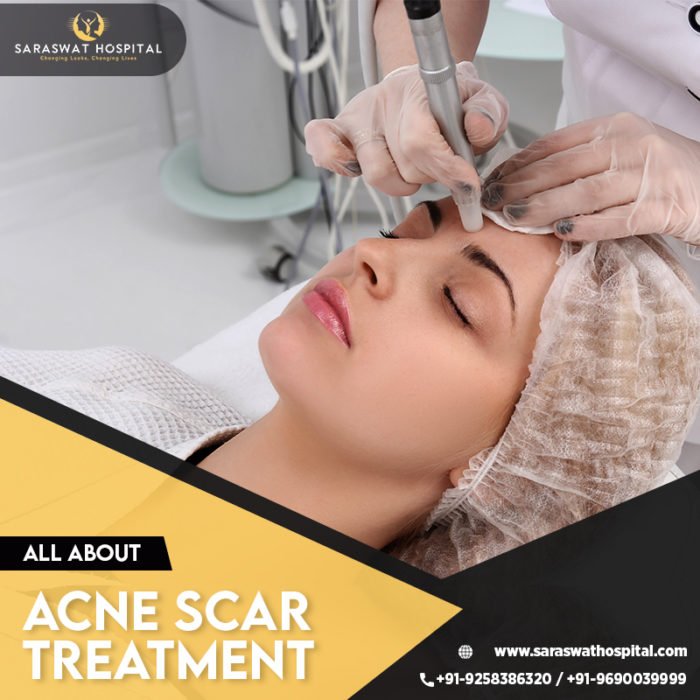 What Should You Know About Acne Scar Treatment?