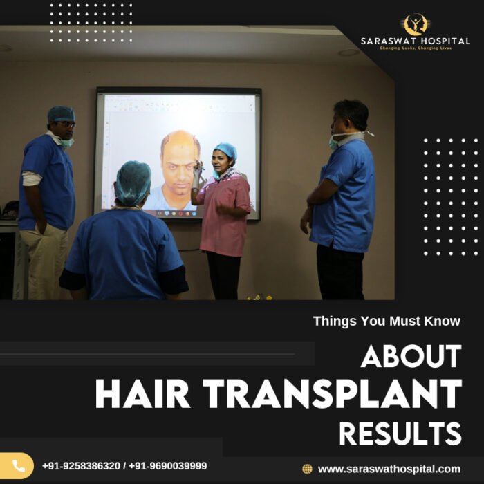 What are the Things You Must Know about Hair Transplant Results?