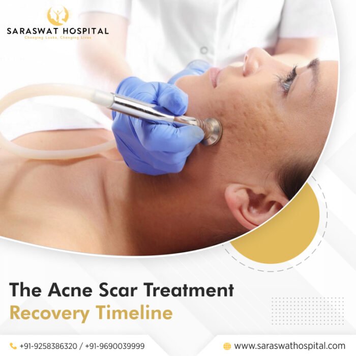 Acne Scar Treatment Recovery Timeline