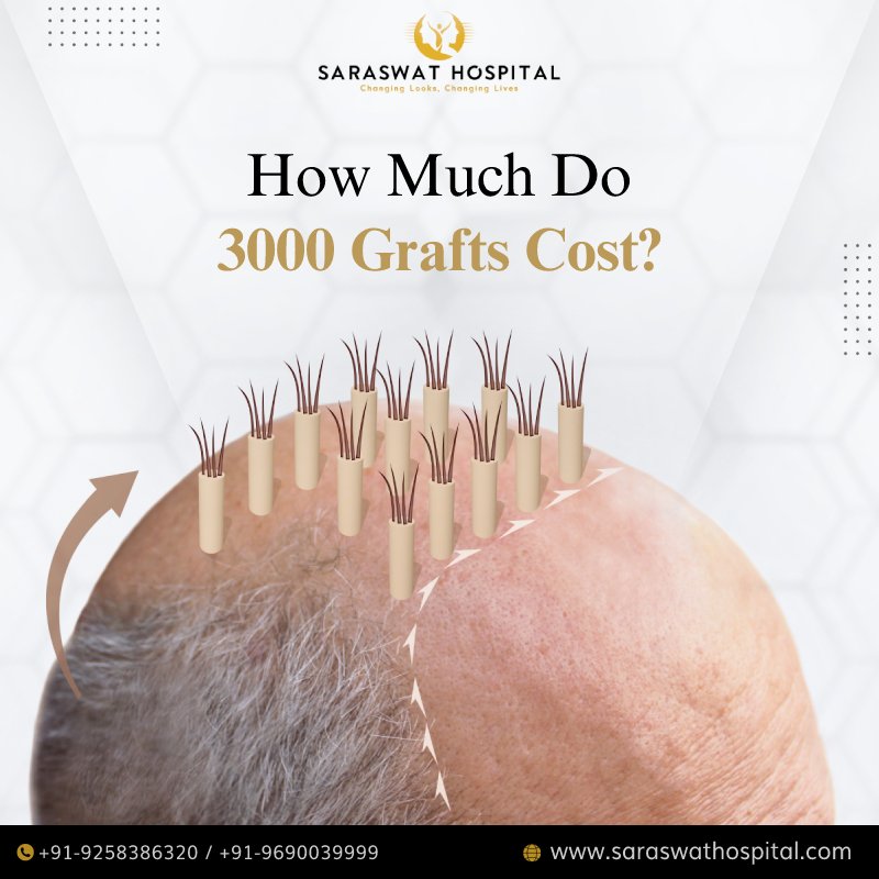 What is the Cost of Implanting 3000 Grafts in Hair Transplant?