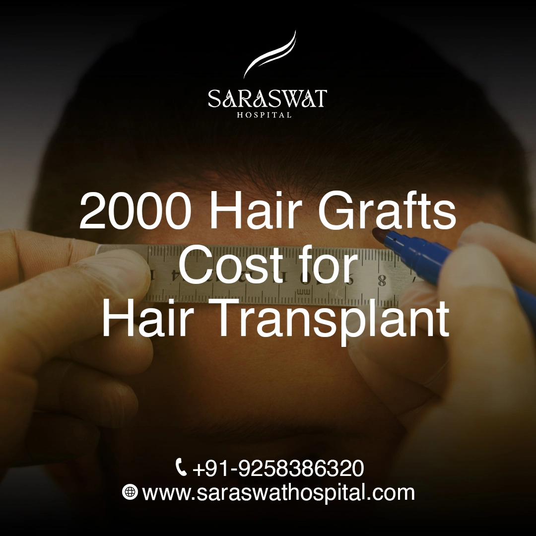 How Much Does 2000 Hair Grafts Cost for Hair Transplant in India?