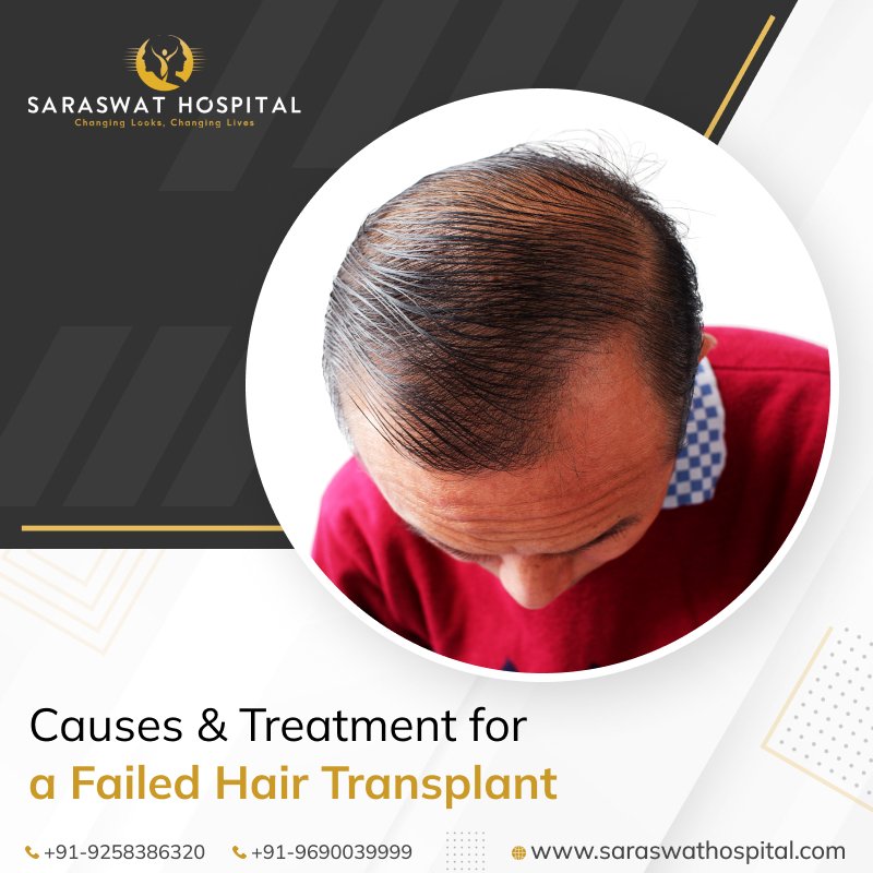 What are the Causes of Failed Hair Transplant?