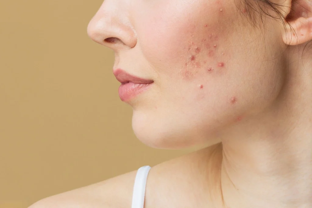 Different Types of Acne Scars