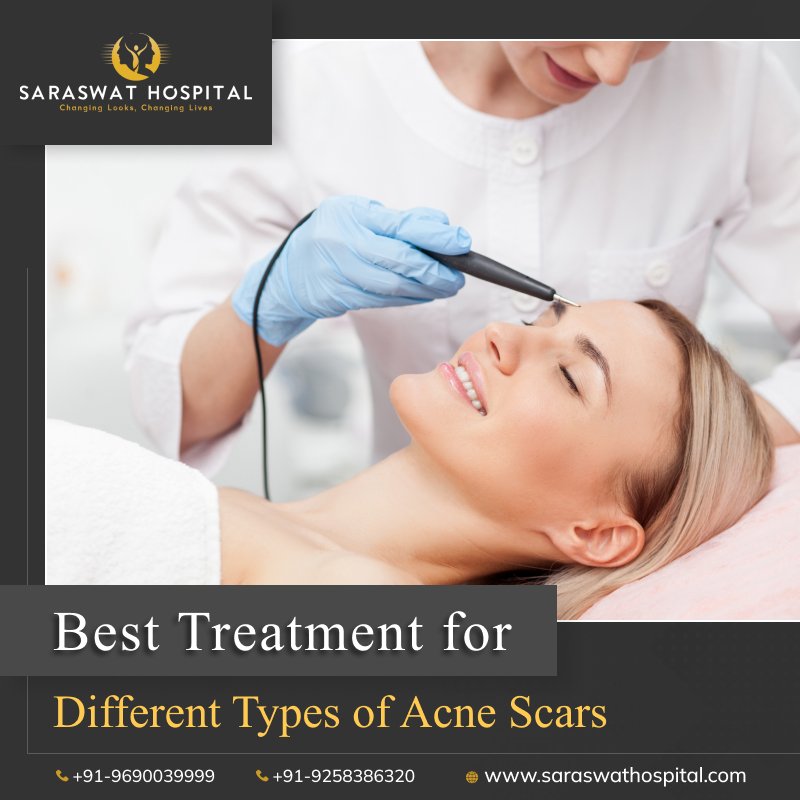 What are the Different Types of Acne Scars and Their Best Treatment?