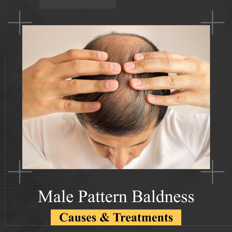 What are the Causes & Treatments for Male Pattern Baldness?