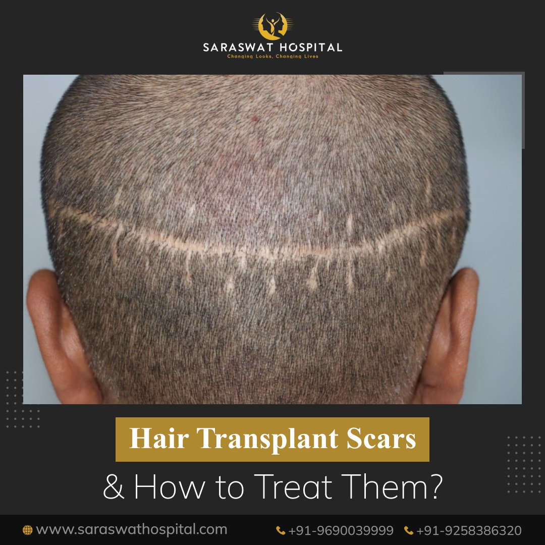 Can Hair Transplants Lead to Scars & How to Remove Them?