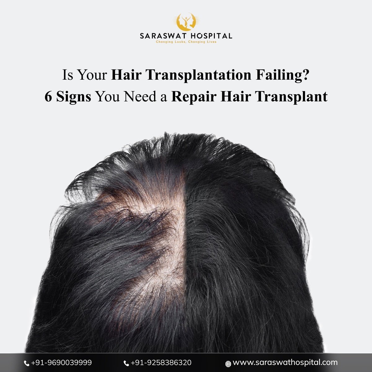 6 Signs You May Need a Repair Hair Transplant