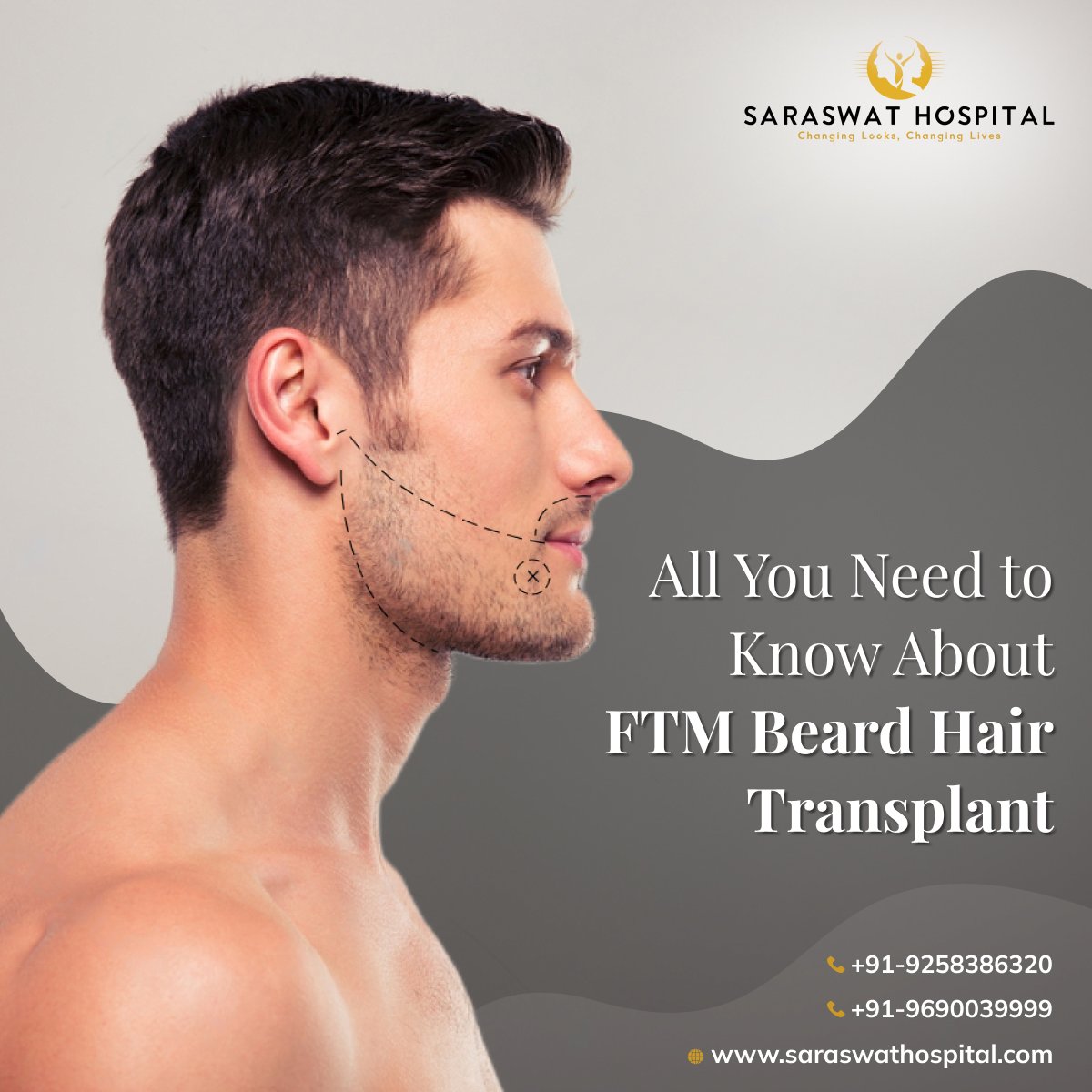 All You Need to Know About FTM Beard Hair Transplant