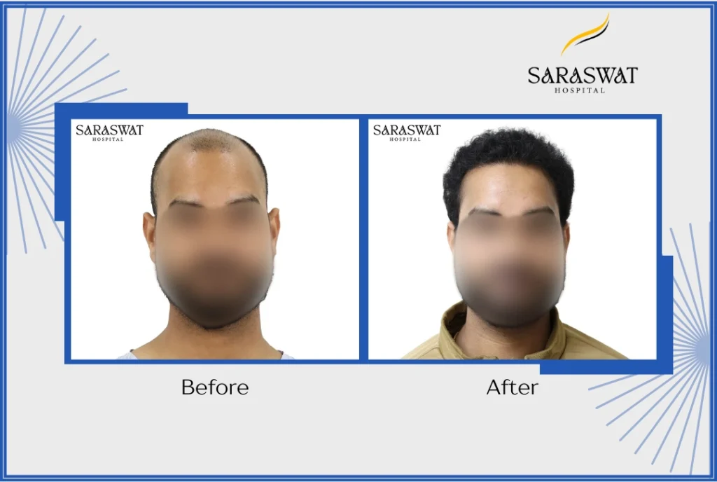 Cost of 3000 grafts in India