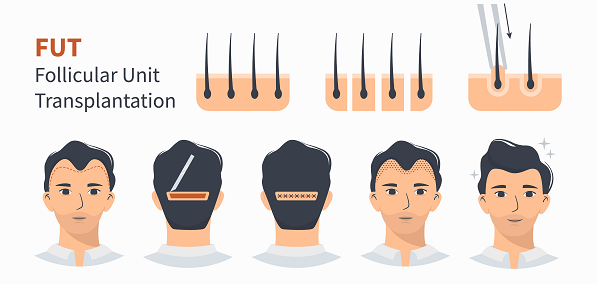 FUT Hair Transplant in India | Follicular Unit Transplantation