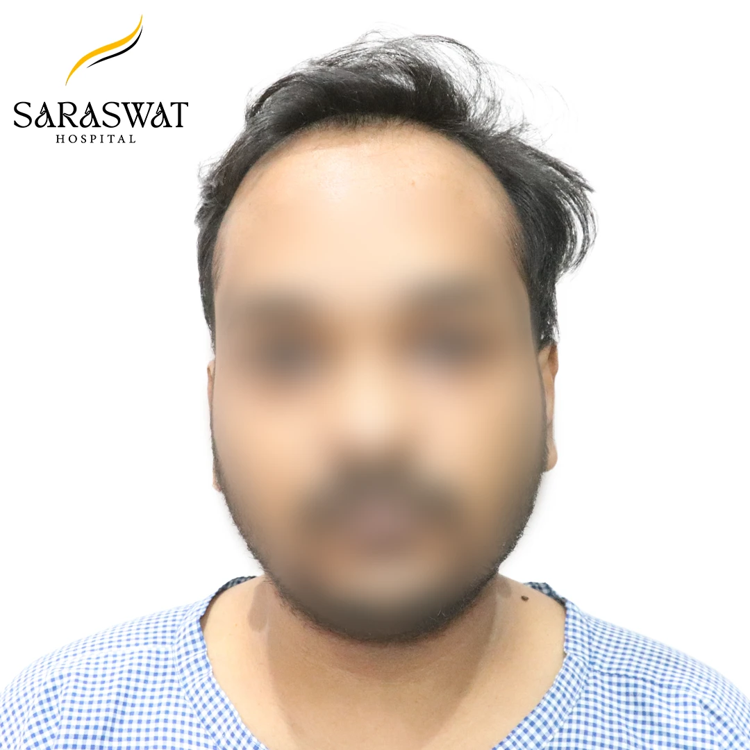 Front FUE Hair Transplant Result Before Procedure