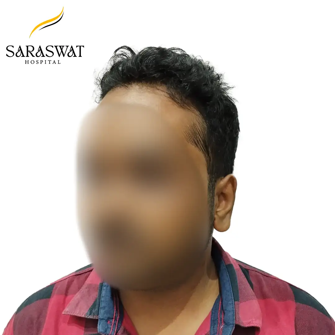 45 Degree FUE Hair Transplant Result After Procedure