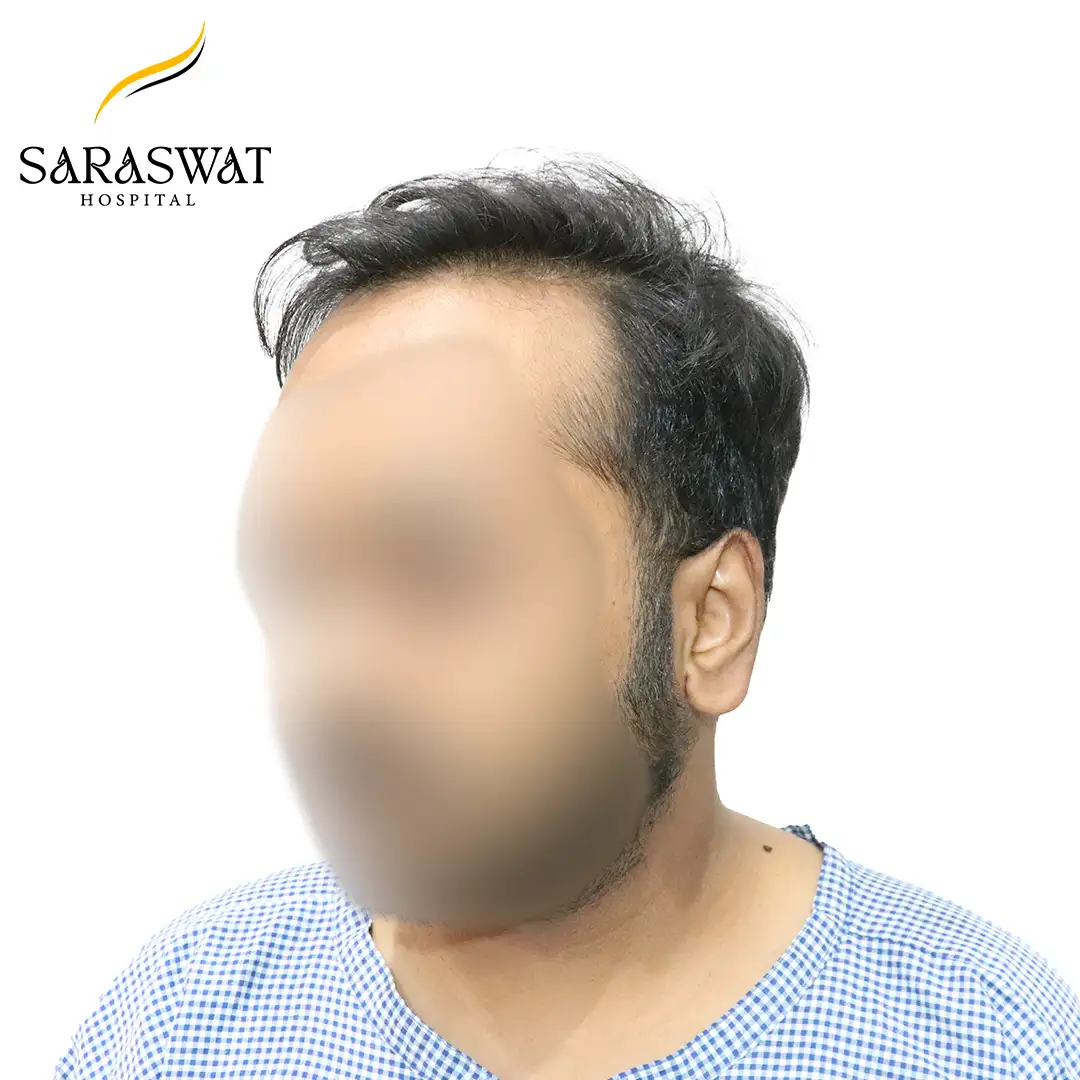 45 Degree FUE Hair Transplant Result Before Procedure