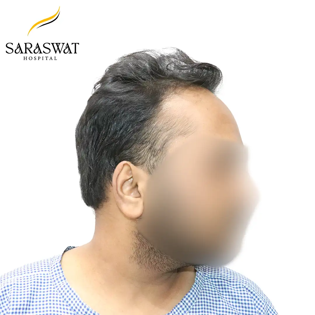 90 Degree FUE Hair Transplant Result Before Procedure