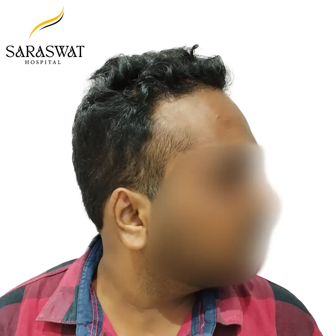90 Degree FUE Hair Transplant Result After Procedure
