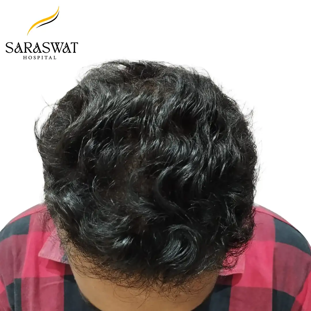 Top FUE Hair Transplant Result After Procedure