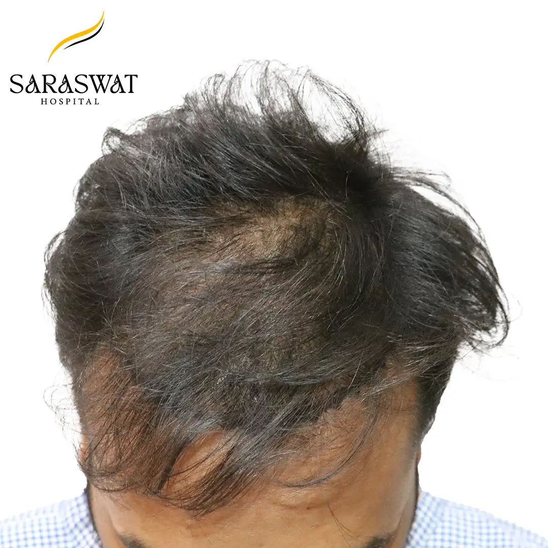 Top FUE Hair Transplant Result Before Procedure