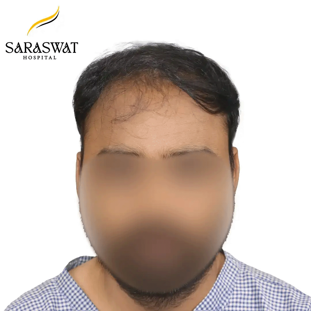 Hair Transplant Before and After Result