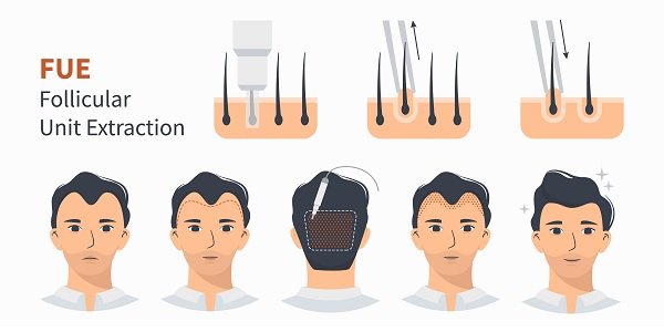 FUE Hair Transplant in India