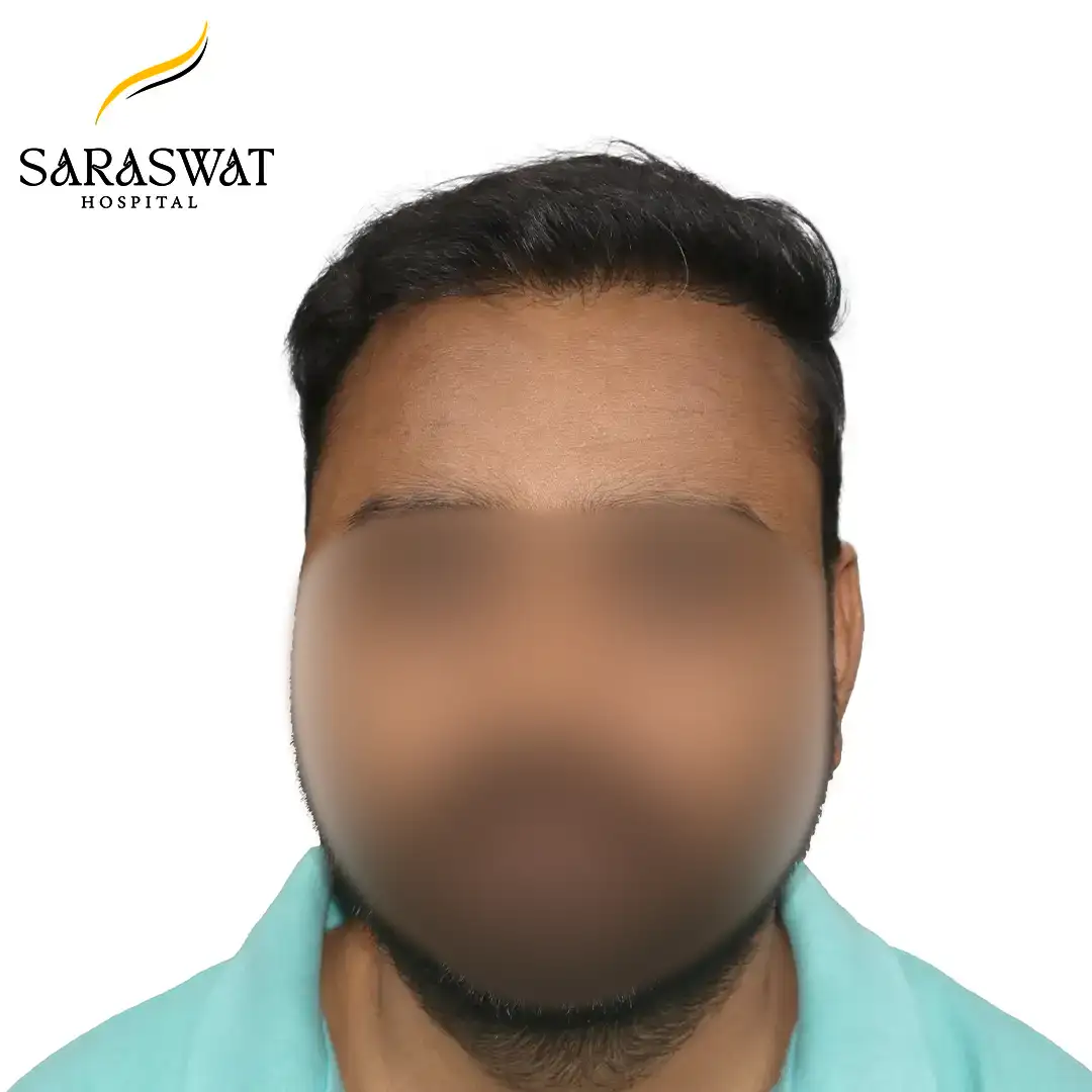 Front FUE Hair Transplant Result After Procedure