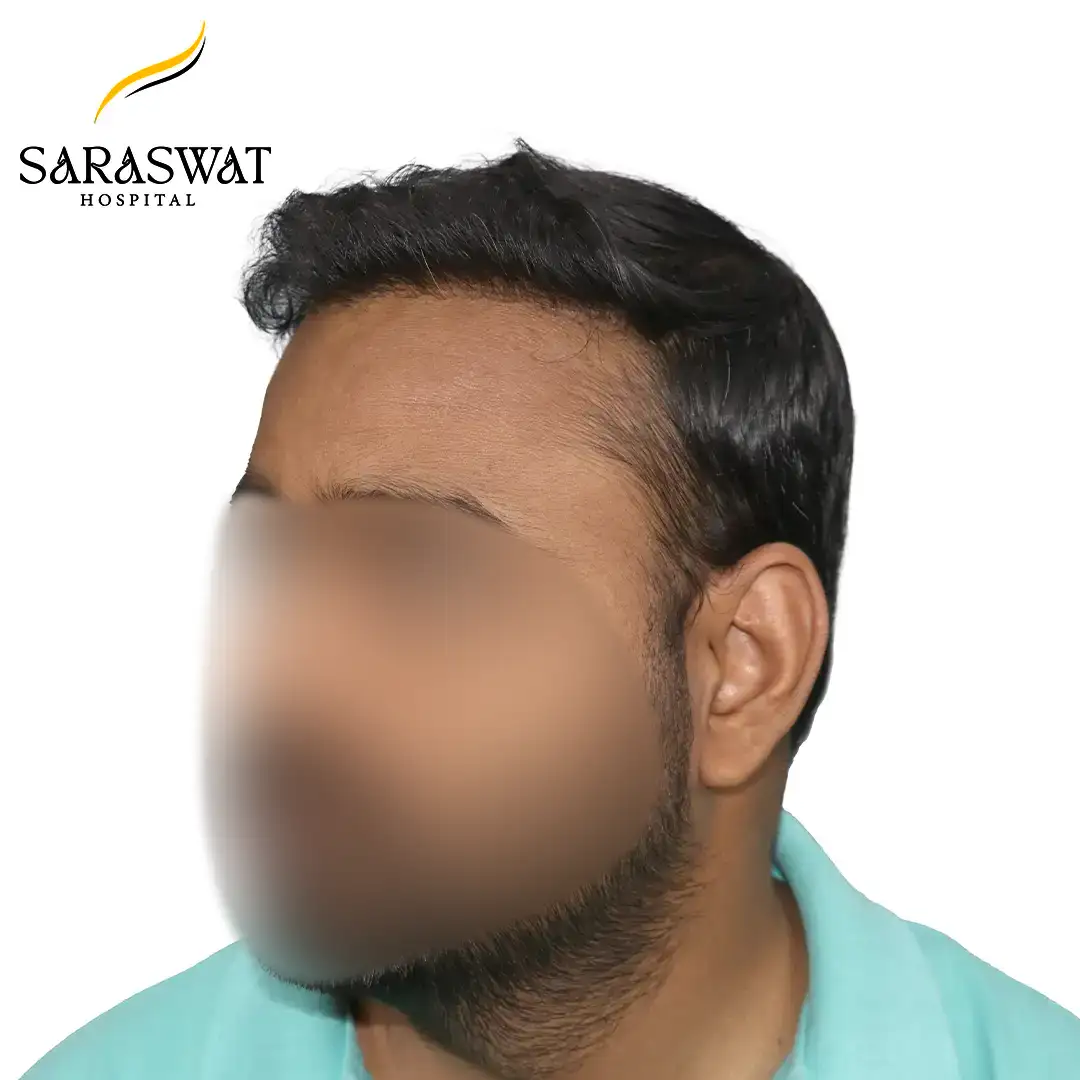 45 Degree FUE Hair Transplant Result After Procedure