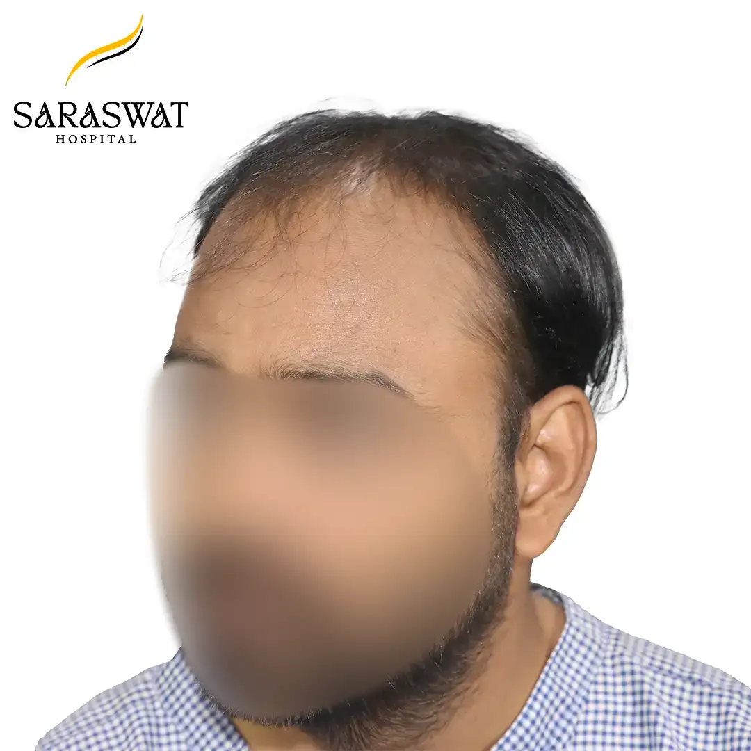 45 Degree FUE Hair Transplant Result Before Procedure