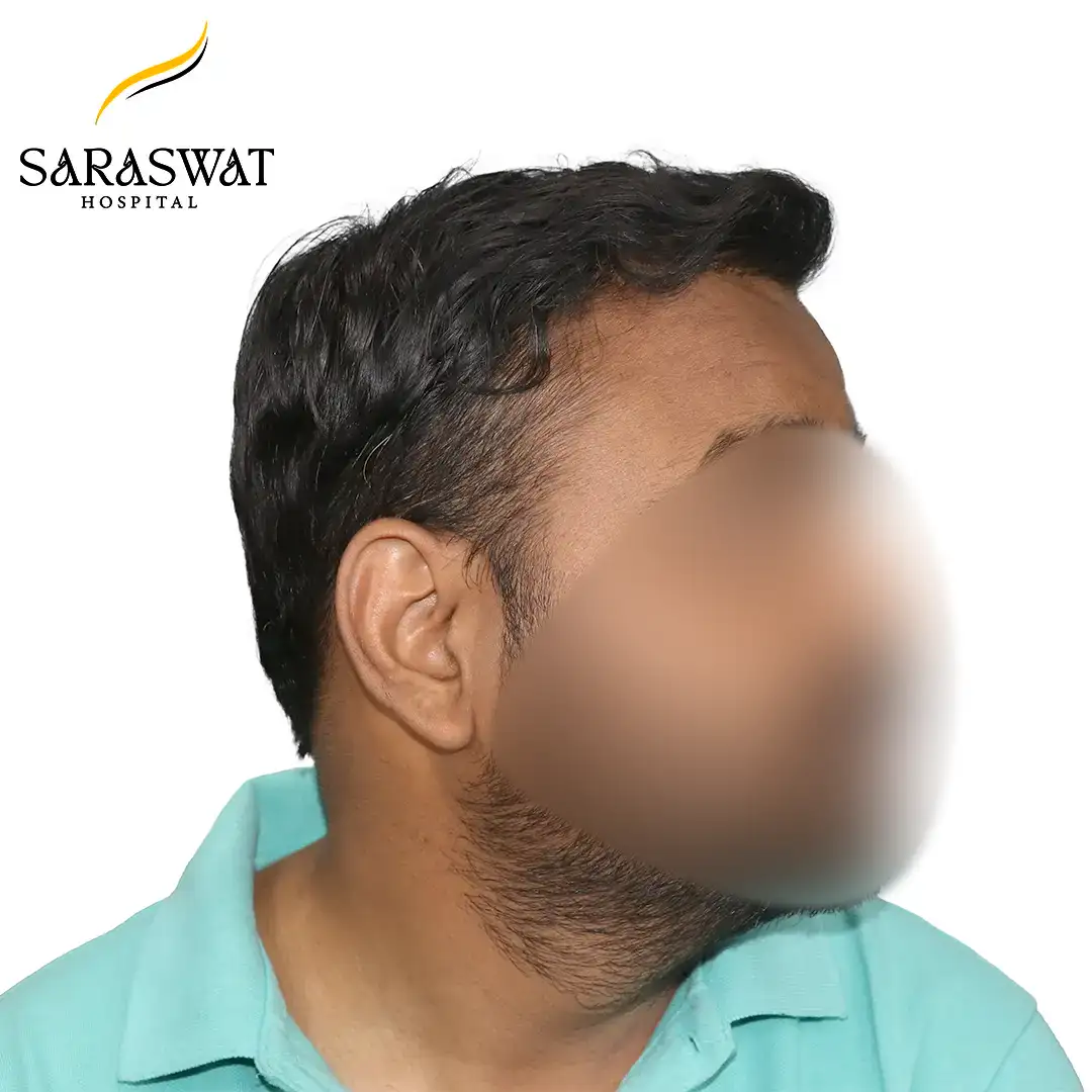 90 Degree FUE Hair Transplant Result After Procedure