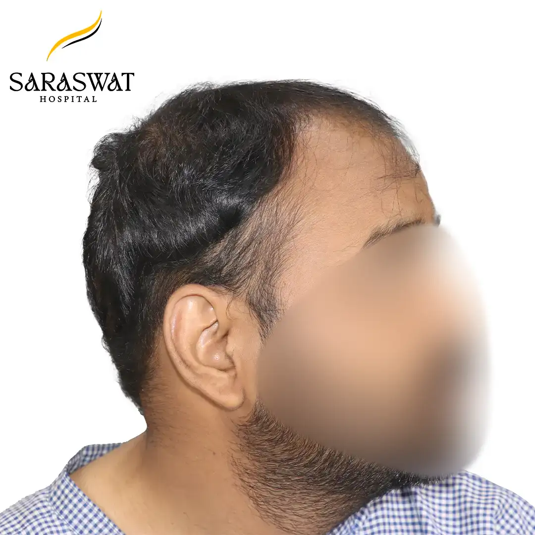 90 Degree FUE Hair Transplant Result Before Procedure