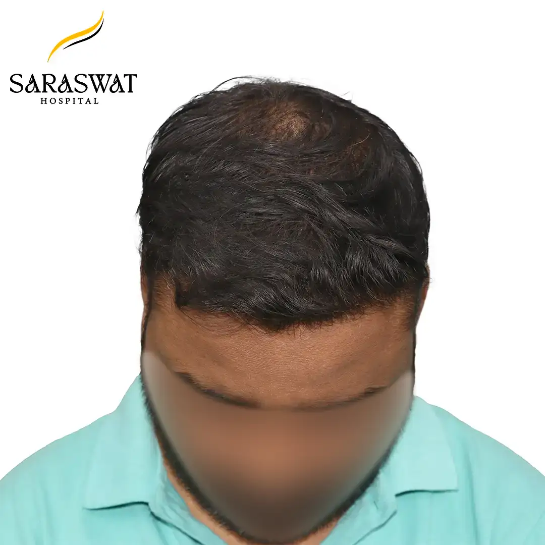 Top FUE Hair Transplant Result After Procedure