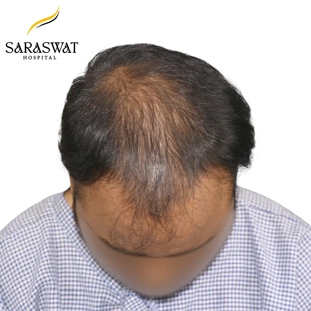 Top FUE Hair Transplant Result Before Procedure
