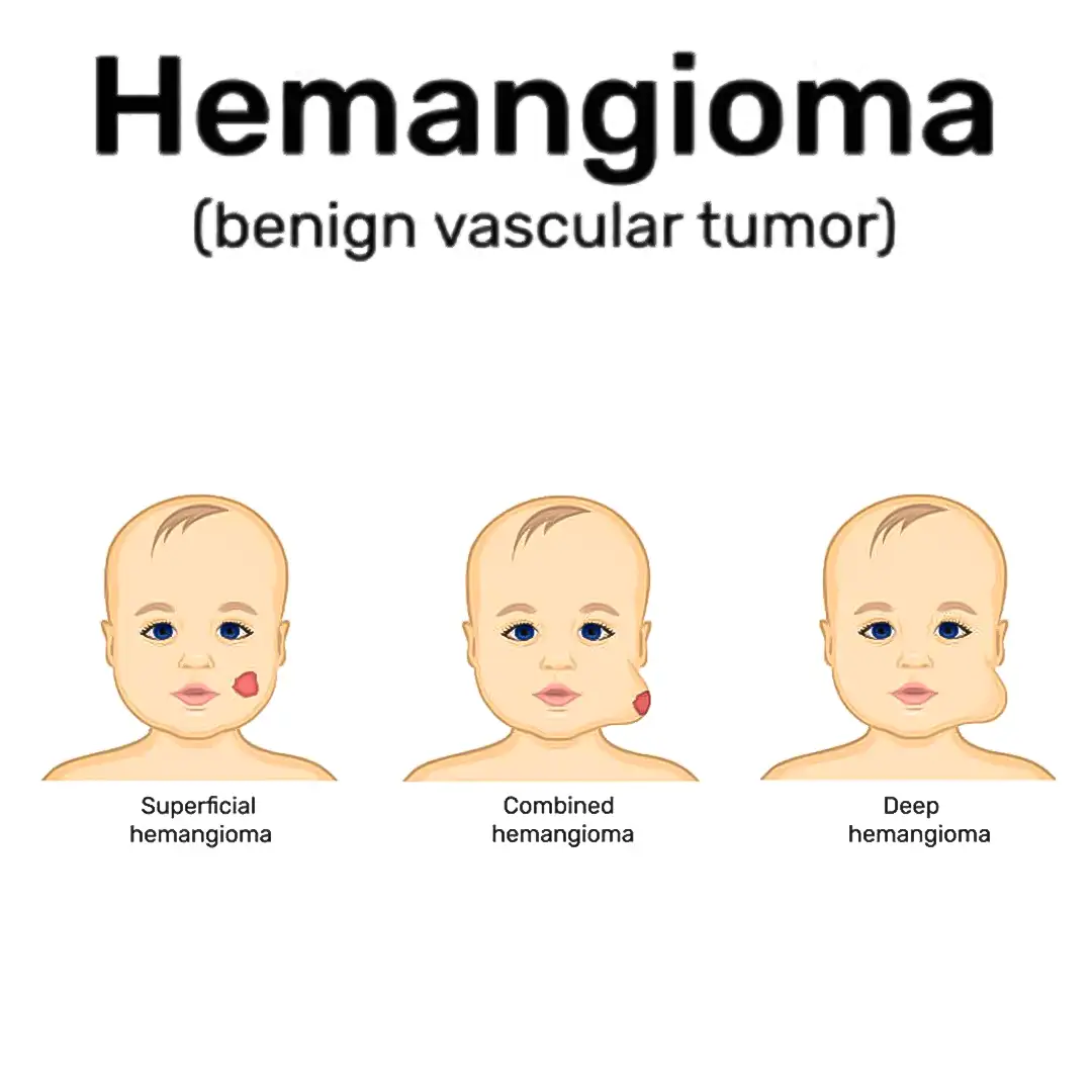 Haemangiomas: Treatment, Causes & Resuls