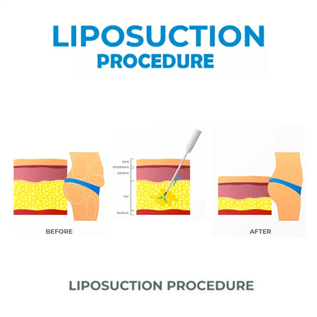Liposuction Surgery in India | Fat Removal Surgery | Cost, Results