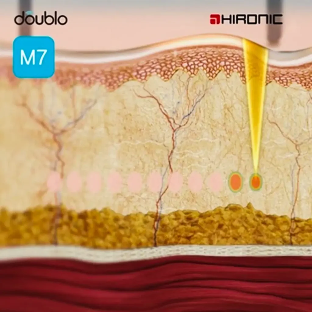 HIFU (High-Intensity Focused Ultrasound)