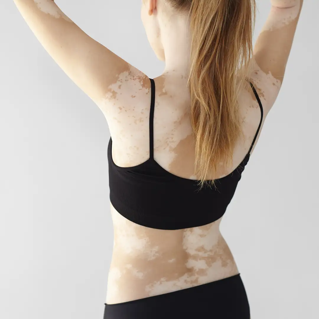 White Spot Removal India | Tinea Versicolor Agra | Vitiligo