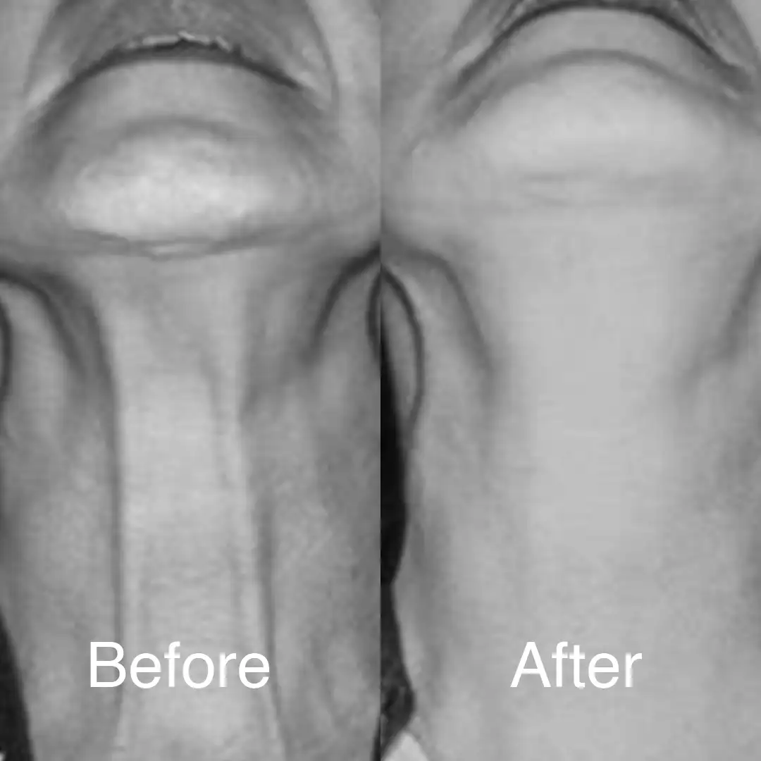 Neck Lift Before and After