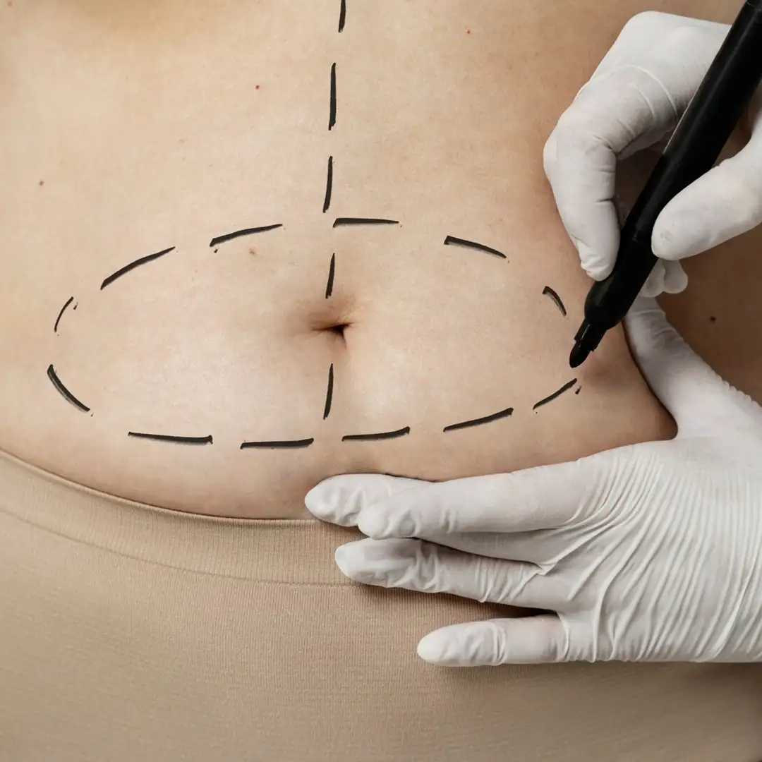 Cost of Tummy Tuck Surgery