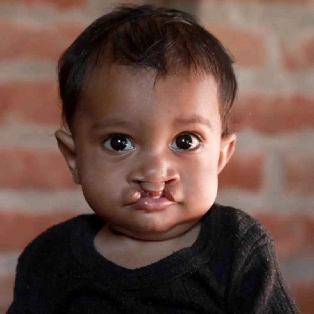Cleft Lip and Cleft Palate Surgery in India