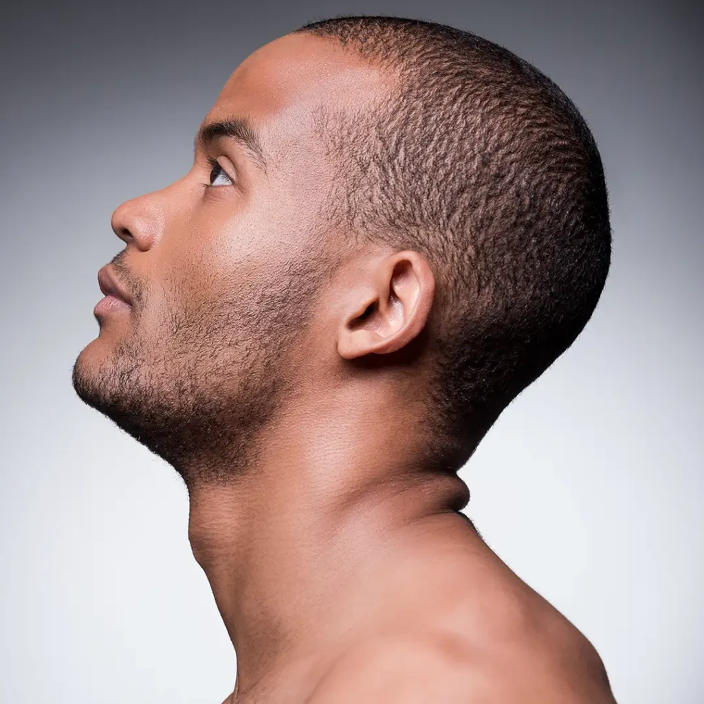 Afro American Hair Transplant