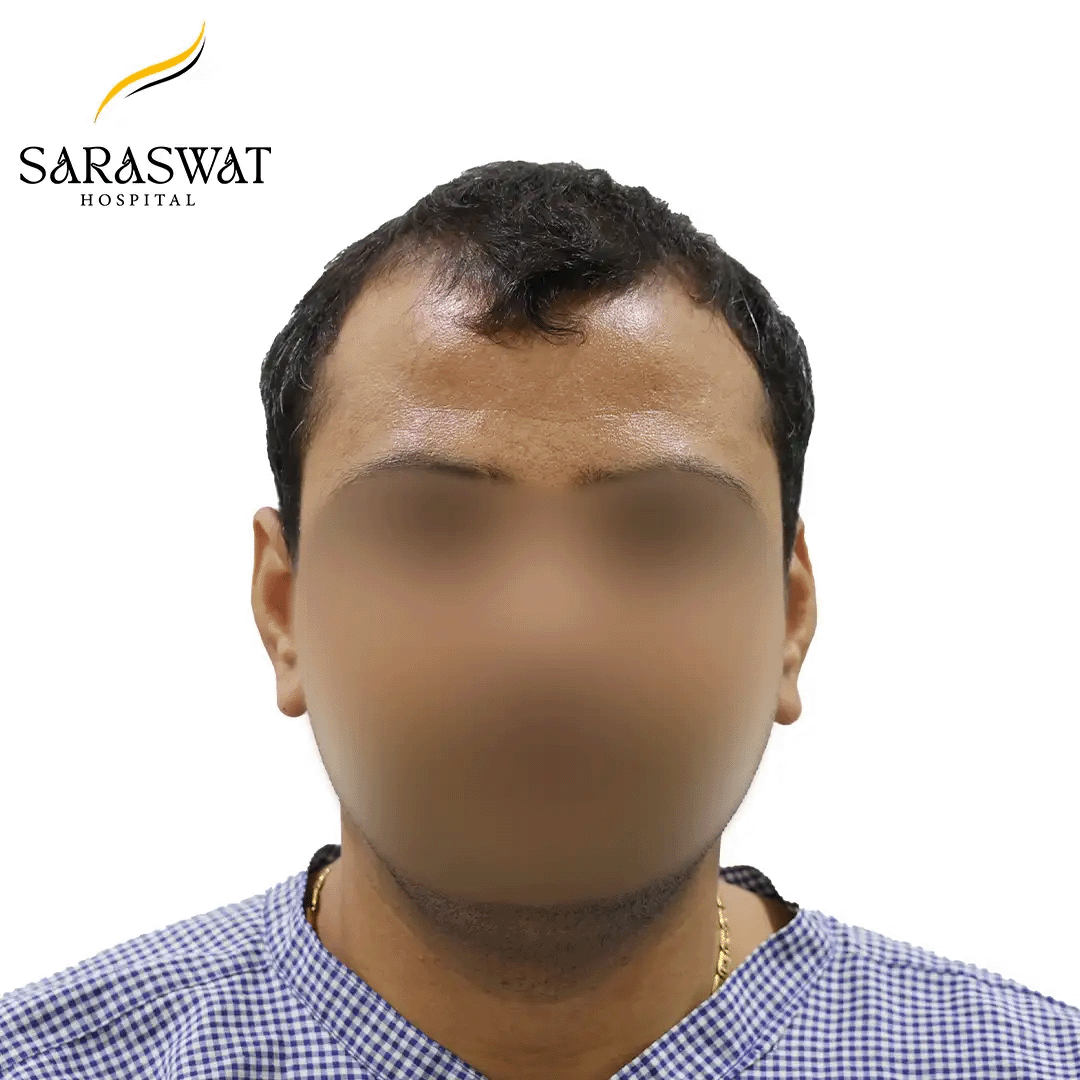 Hair Transplant Before and After Result