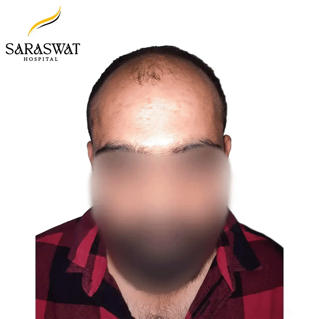 Hair Transplant Before and After Result