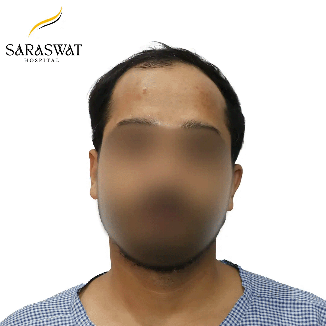 Hair Transplant Before and After Results