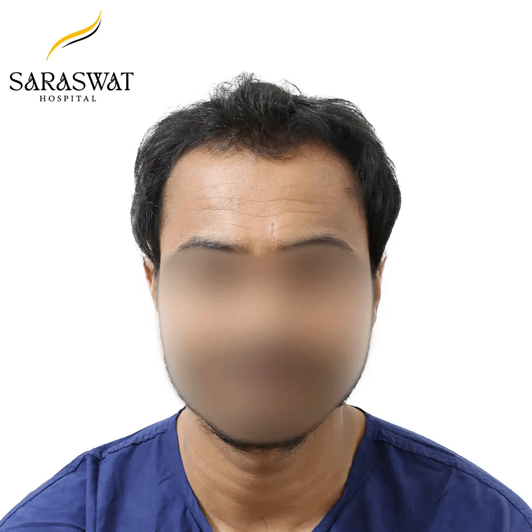 Hair Transplant Before After