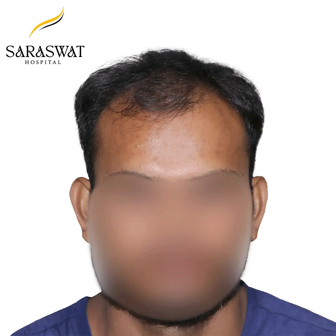 Hair Transplant Before and After Results