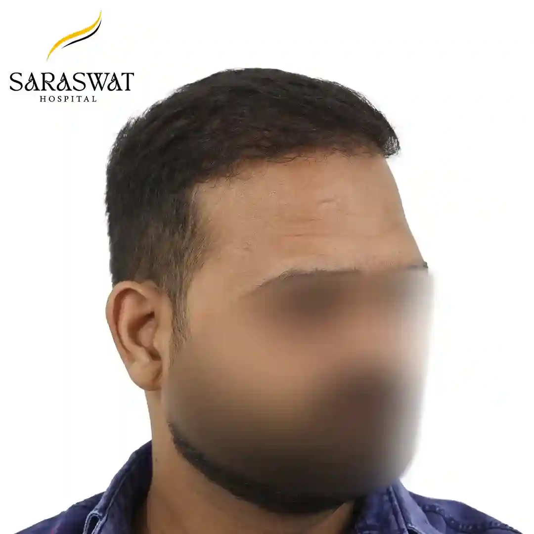 Hair Transplant Before After