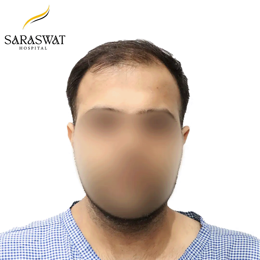 Hair Transplant Before and After Results