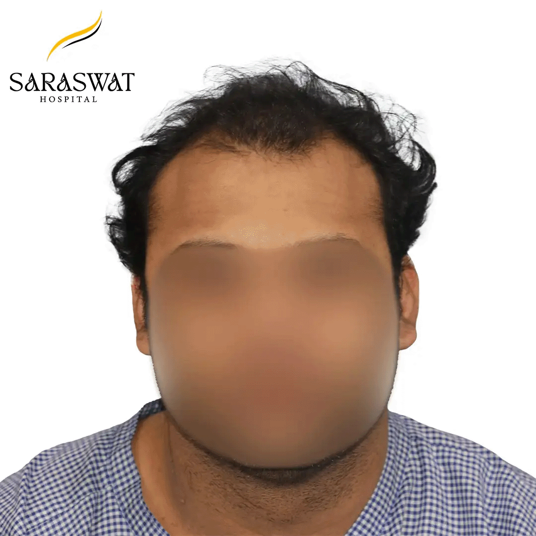 Hair Transplant Before and After Results