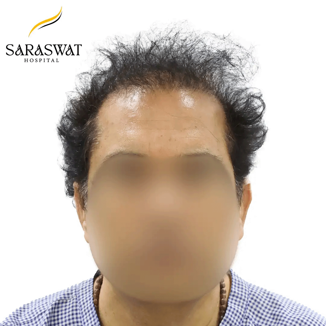 Hair Transplant Before and After