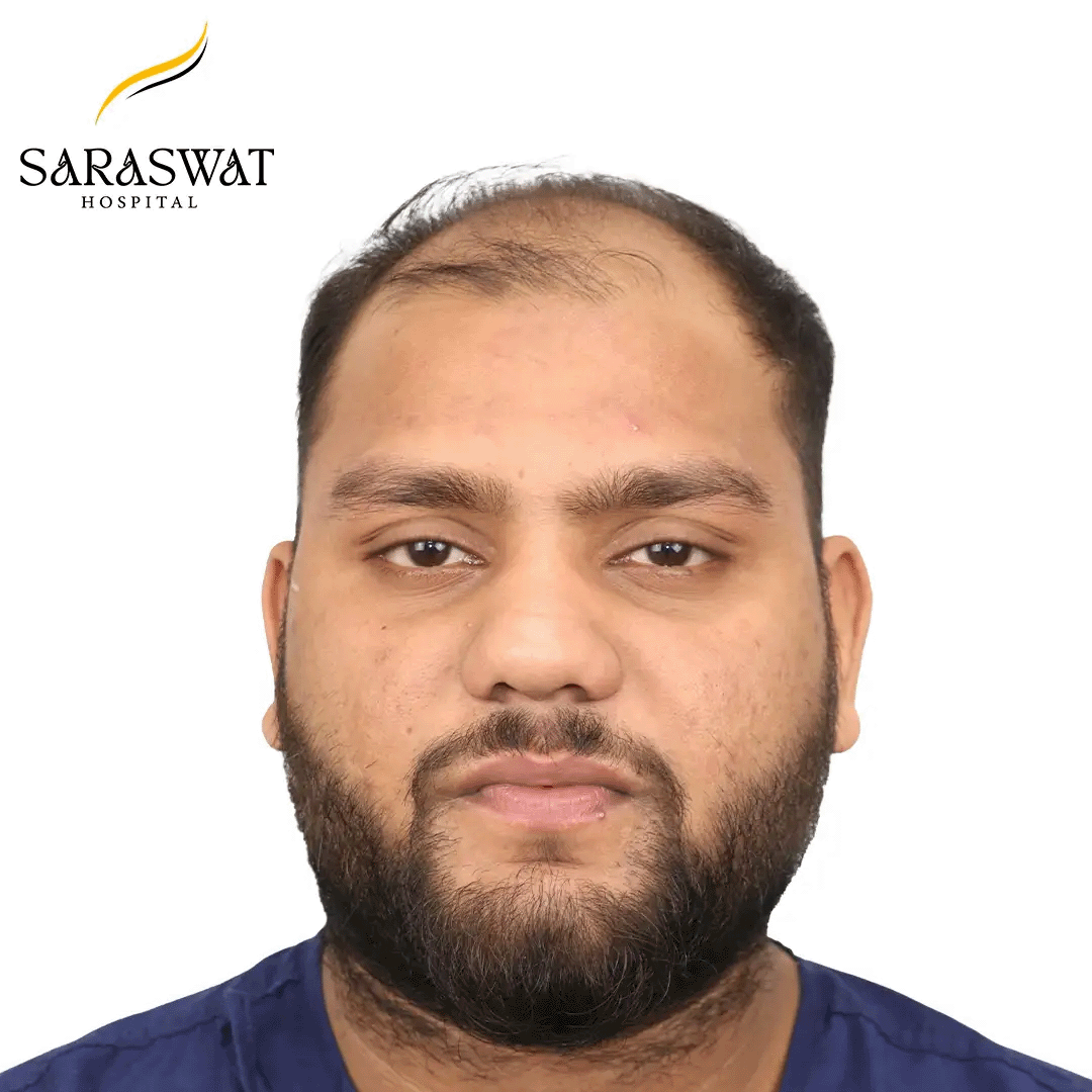 Hair Transplant Before and After Results