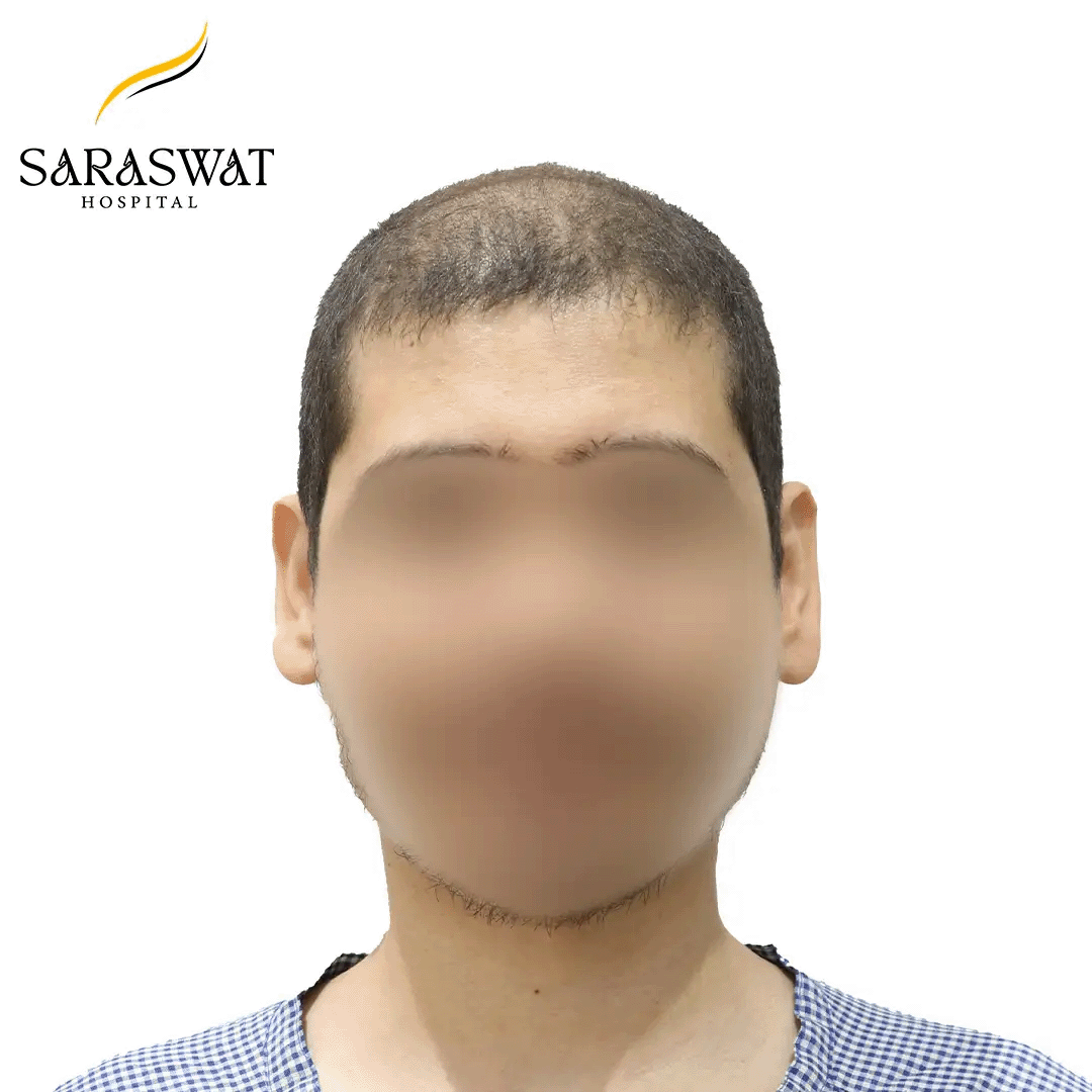 Hair Transplant Before and After Results